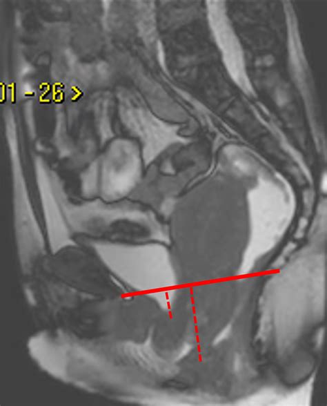 Translabial Us And Dynamic Mr Imaging Of The Pelvic Floor Normal Anatomy And Dysfunction