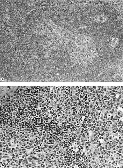 Figure 1 From Progressive Transformation Of Germinal Centers Semantic