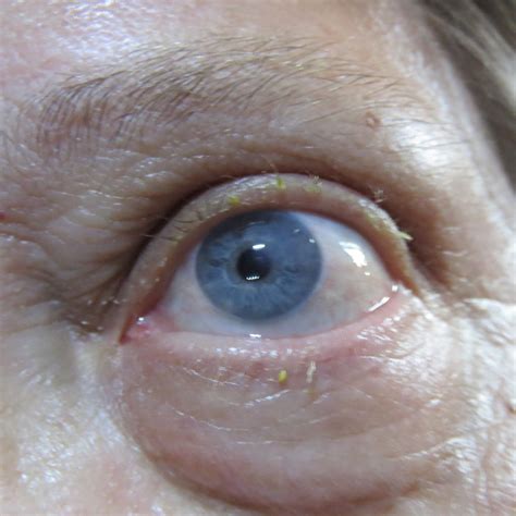 Eye Post Surgery 7 12 18 After Cataract Surgery Flickr