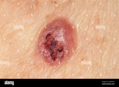 Close Up Of A Nodular Type Of Basal Cell Carcinoma Bcc Or Rodent