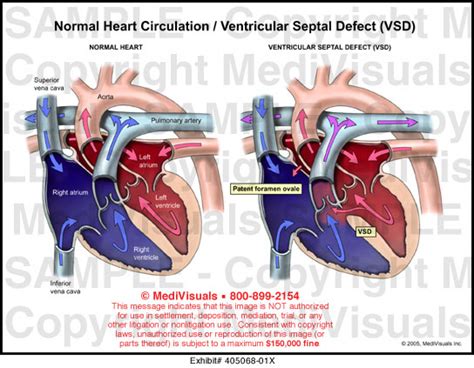 Medivisuals Normal Heart Circulation Ventricular Septal Defect Vsd