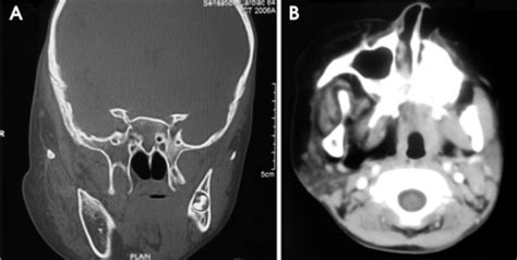 Coronal A And Axial B Ct Images Bone Window And So Open I