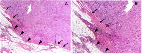 Cancers Free Full Text Extracapsular Lymph Node Involvement In