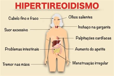 Hipertireoidismo como identificar e fatores de risco Tua Saúde