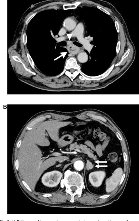 Figure 1 From A Black Adrenal Adenoma With High Fdg Uptake On Petct