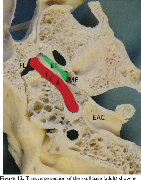 Figure 12 From Endoscopic Anatomy Of The Pediatric Middle Ear