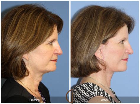 Facelift Fifties Before And After Photos Patient 57 Dr Kevin Sadati