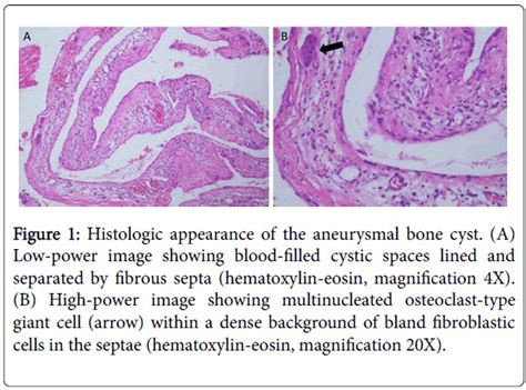 Aneurysmal Bone Cyst Histology