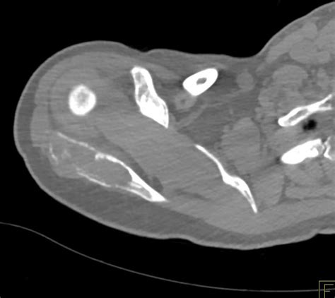 Aneurysmal Bone Cyst Of The Scapula Musculoskeletal Case Studies