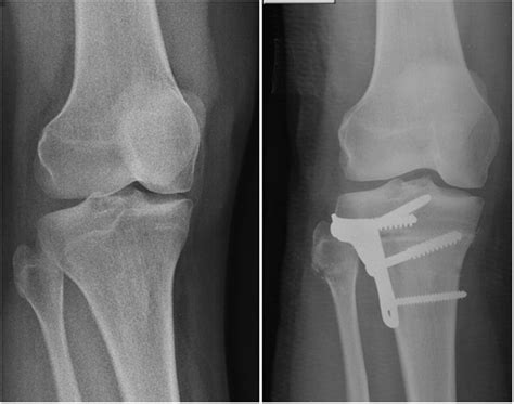 High Tibial Derotation Osteotomy For Distal Extensor Mechanism