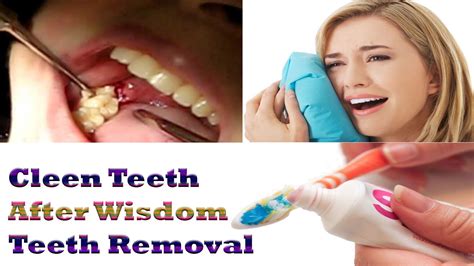 Wisdom Teeth Removal How To Clean Your Teeth After Wisdom Teeth Removal Youtube