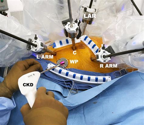Minimally Invasive And Robot Assisted Mitral Valve Surgery Adult And