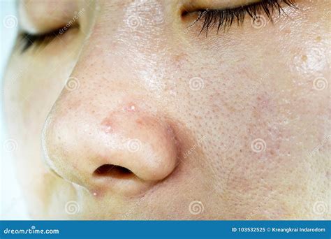 Skin Problem With Acne Diseases Close Up Woman Wrinkle Face With