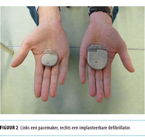 A pacemaker or icd has 3 main parts: Explantatie van een implanteerbare defibrillator of ...
