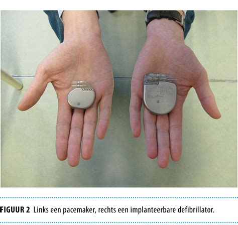 While pacemaker's job is to treat slow heart rate, icd's job icd ( implantable cardiac defibrillator) on the other hand senses a very fast or chaotic rhythm. Explantatie van een implanteerbare defibrillator of ...