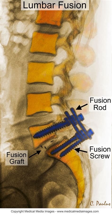 Side View Lateral Color X Ray Of A Lumbar Fusion With Annotations Ideal For Websites And
