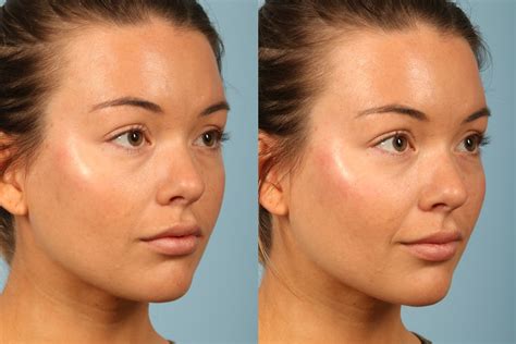 Contouring With Makeup Or With Fillers Kavali Plastic Surgery And