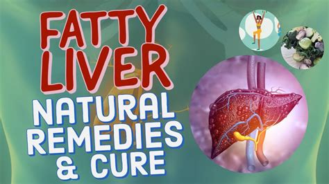 Fatty Liver Natural Remedies And Cures By Dr Willie Ong Internist
