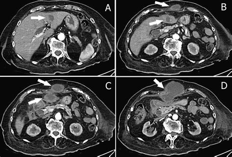 Abdomen Ct Scans Show A The Liver Abscess In The Left Hepatic Lobe