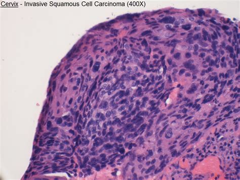 G Cervix Invasive Squamous Cell Carcinoma 400x