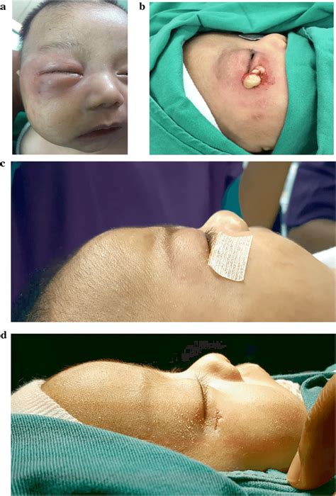 A Right Facial Abscess Causes Swelling And Extension To Zygoma And Download Scientific Diagram