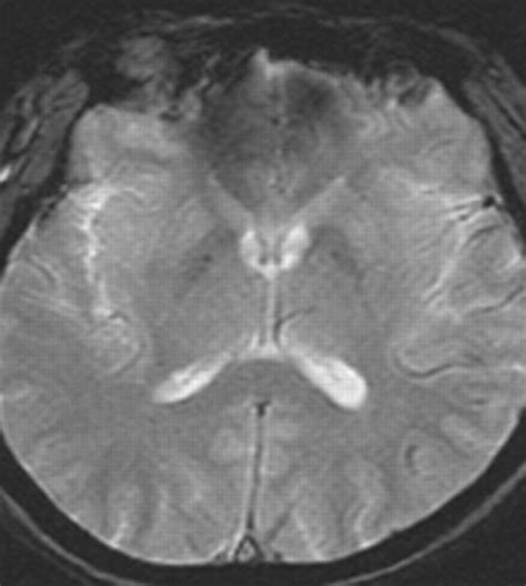Multiple Cerebral Microbleeds In Hyperacute Ischemic Stroke Impact On