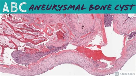 Aneurysmal Bone Cyst Abc 5 Minute Pathology Pearls Youtube