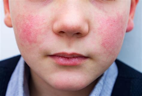 What To Know About Fifth Disease In Kids The Well By Northwell