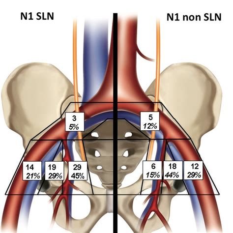 Anatomical Distribution Of Sentinel Lymph Nodes Sln By Download