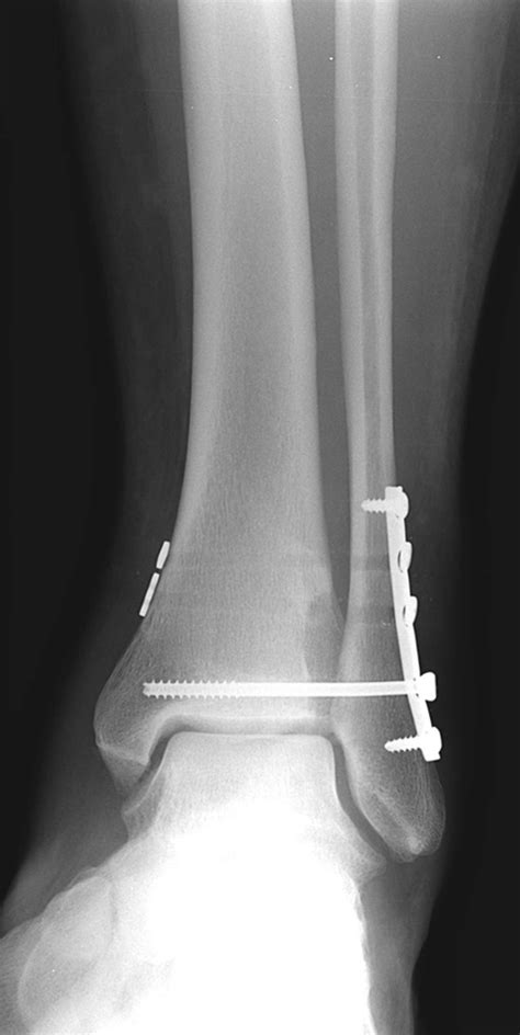 Postoperative Anterior Posterior Ankle Radiograph After Open Reduction