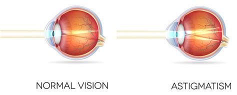 Exeter Eye Normal Vision Vs Astigmatism Side View Diagram Exeter Eye