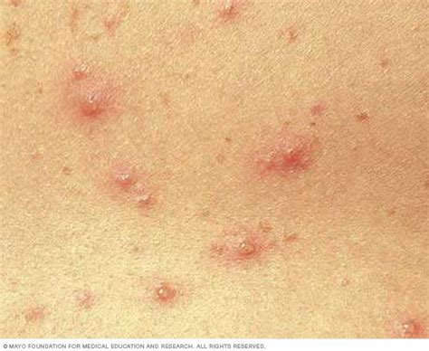 Chickenpox Symptoms And Causes Mayo Clinic