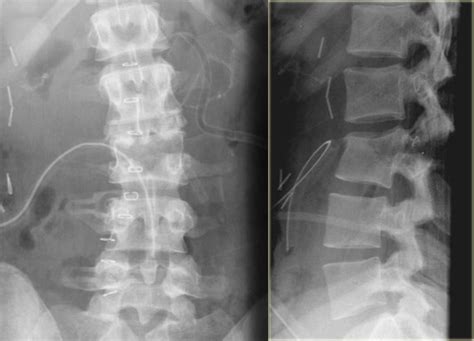 Lumbosacral Apl X Ray Lumbar Spine Flexion And Extension Views