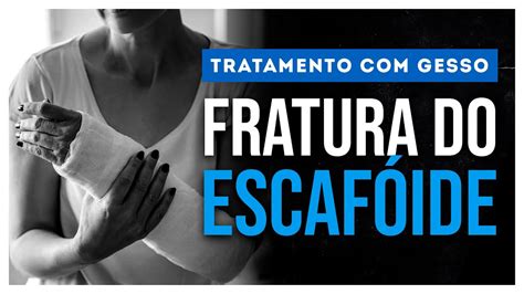 Fratura Do EscafÓide Saiba Como É O Tratamento Com Gesso Youtube