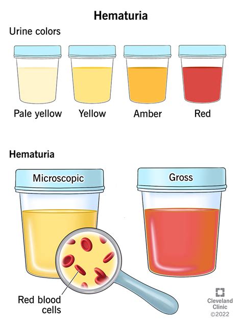 Blood In Urine Hematuria Causes Diagnosis And Treatment