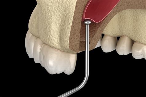 What To Expect If You Need A Sinus Lift Before Getting Dental Implants