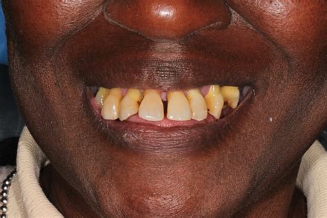 Dental Implants All Smiles Dental