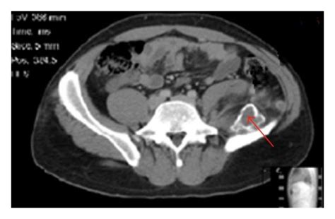 Ct Scan A Axial View At L3 Showing The Distinct Peripheral