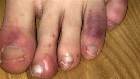 Covid Symptoms Rash On Toes Proactive Podiatrists Seeing Covid Toes