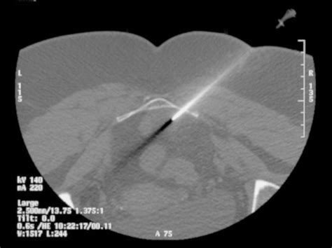 Ct Guided Biopsy Through Presacral Lesion Using Posterolateral Approach