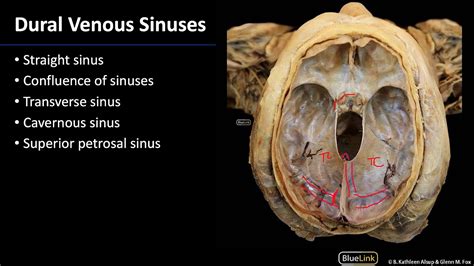 Inferior Sagittal Sinus Cadaver