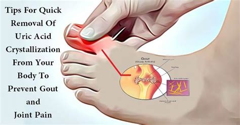 Arthritis In The Bones In The Feet Is Often Caused By Malfunction Of The M Rheumatoid