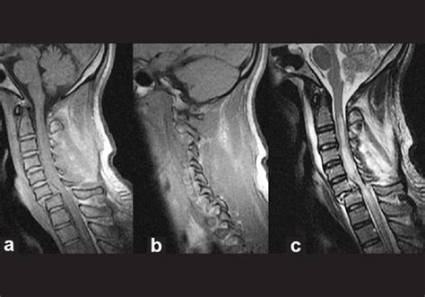 T1 And T2 Weighted Sagittal Mri Scans Showing The Traumatic