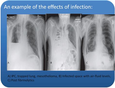 A malignant pleural effusion may be large and diffuse or small and involve just a small portion of the pleural cavity. Infections in Invasive Pleural Procedures: A Single Centre Experience