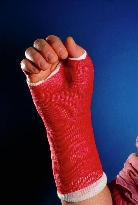 Injured Wrist Bandaged With A Fibreglass Cast Photograph By Medical