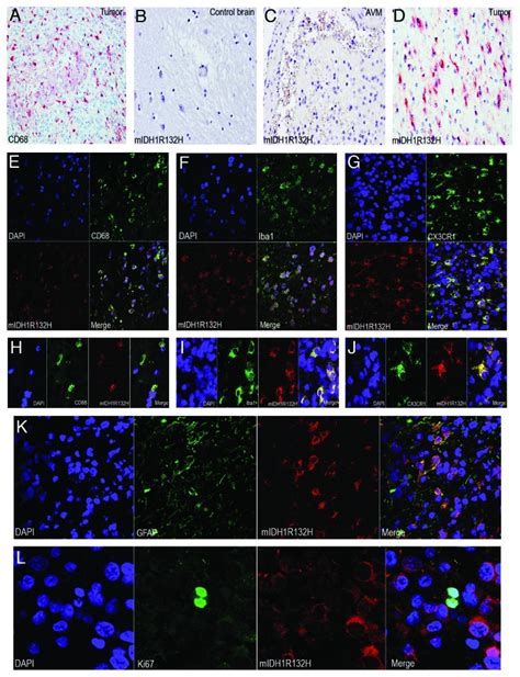 Mutant Idh1r132h Detected In Glioma Infiltrating Microgliamacrophages