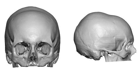 Plastic Surgery Case Study Custom Skull Implant Correction Of A
