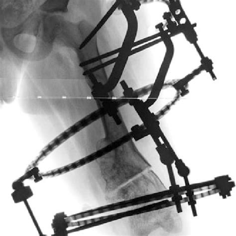 Postoperative Ap Radiograph Of The Femur After Distal Femoral Osteotomy