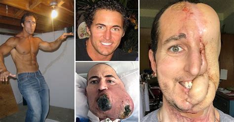 If you've found a lump on your dog, how can you tell if it's cancer or not? Man who lost half his face to cancer successfully has face ...