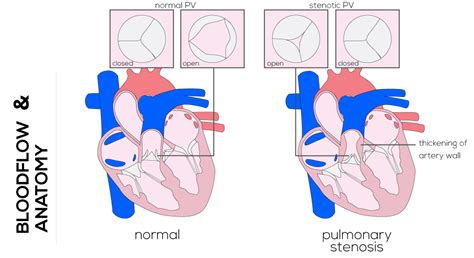 Congenital Defects Tutorial Congenital Heart Defects Atlas Of Human
